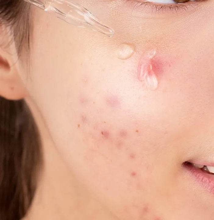 Care:Nel Niacinamide Zinc Serum 1 fl oz (30 ml) - OthoiMart